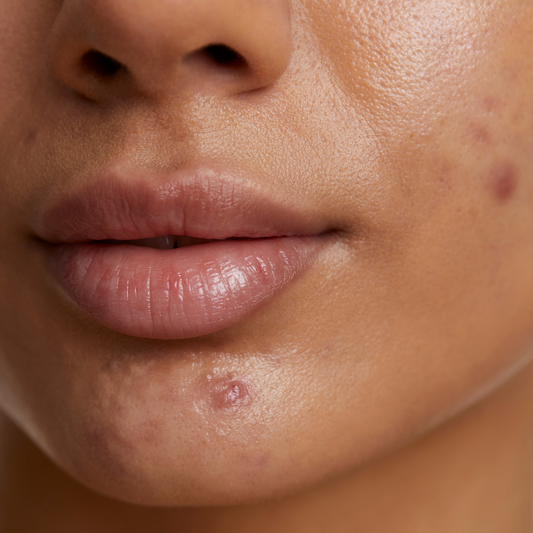 A acne na mulher adulta