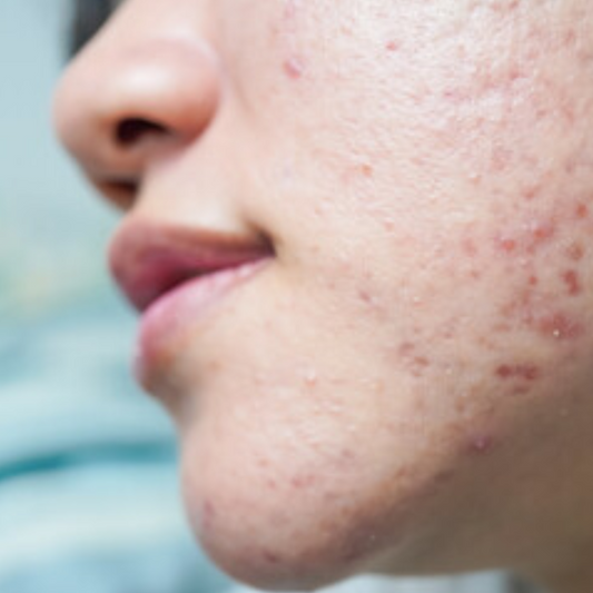 Como a rotina de skincare pode ajudar a pele oleosa e acneica?