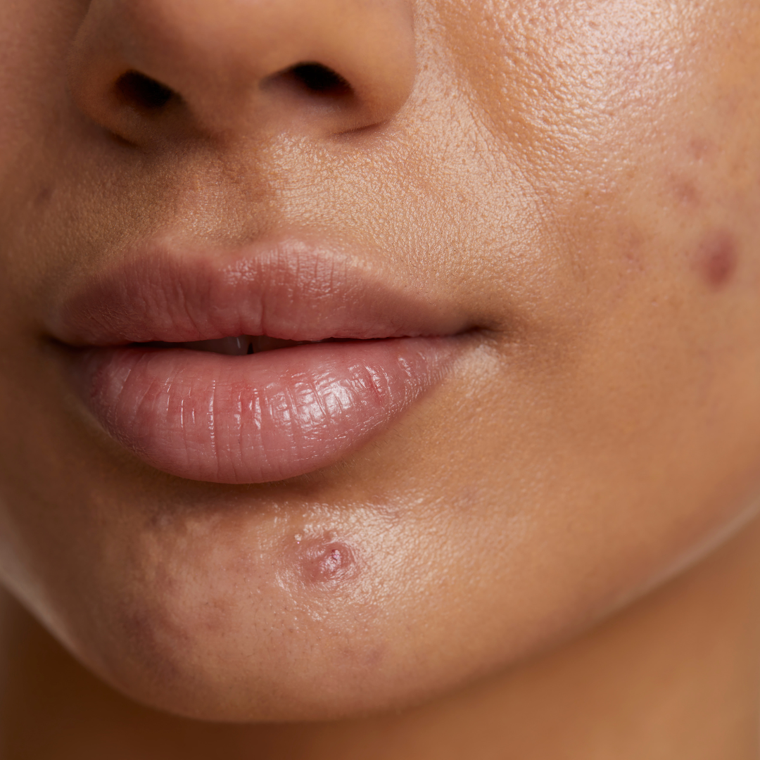 A acne na mulher adulta